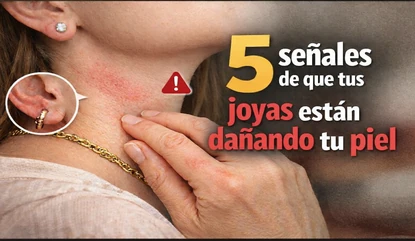 joyas que dañan la piel con metales tóxicos como el níquel