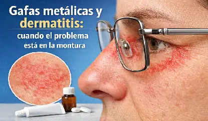 Persona mayor con dermatitis facial causada por montura metálica de gafas con enrojecimiento visible en mejilla y sien